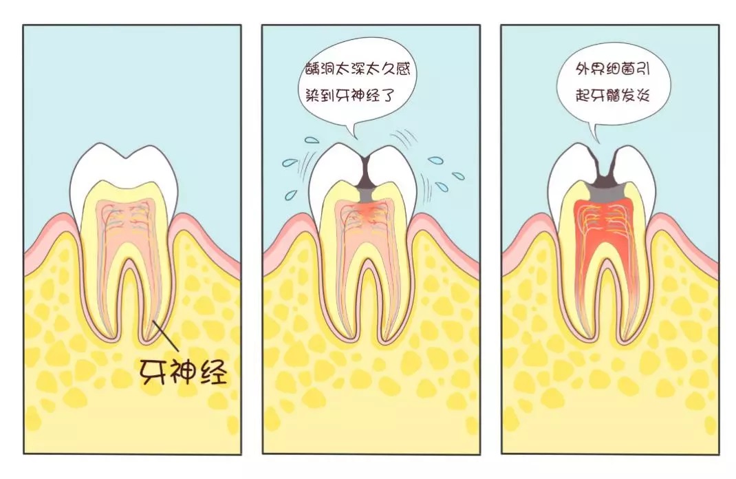 牙齿剧烈疼痛可能是牙髓炎，需要及时治疗